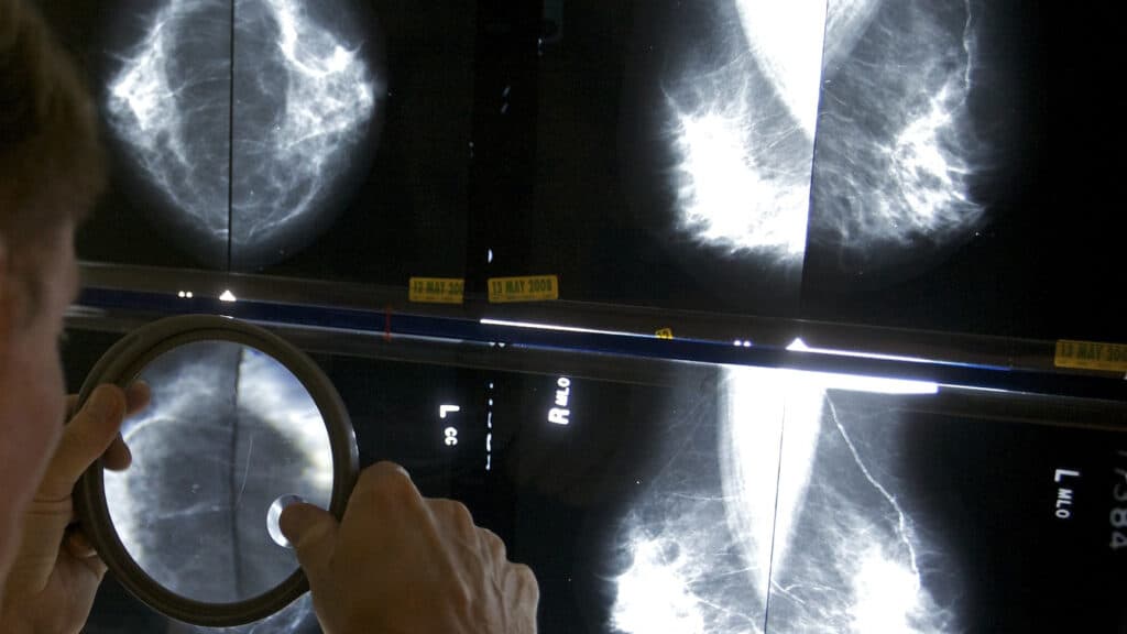 STAT+: AI for breast cancer risk prediction goes DTC, regulatory cloud over Utah sandbox, and AI psychosis