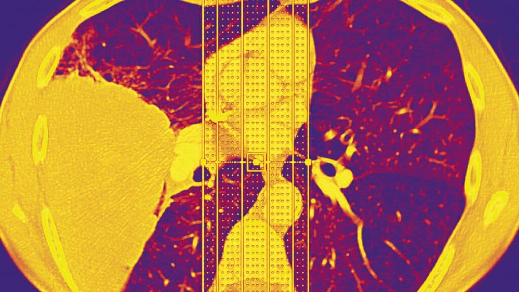 STAT+: Why do ‘never-smokers’ get lung cancer? In some cases, rare genetic variant may be a factor
