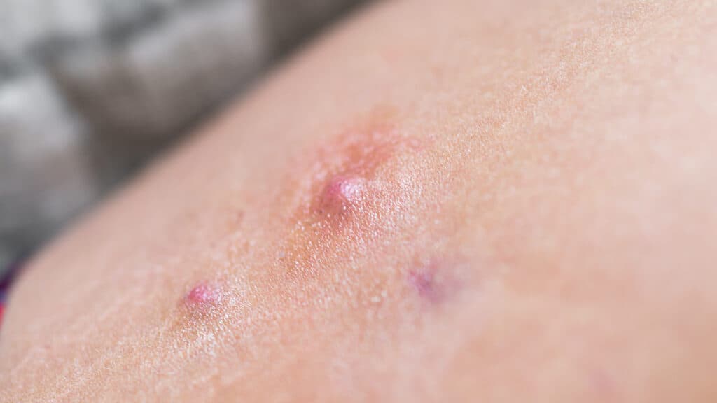 STAT+: AbbVie skin disorder drug succeeds in late-stage trial, but results miss market expectations